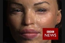 BBC News – Katie Piper gets her sight back!